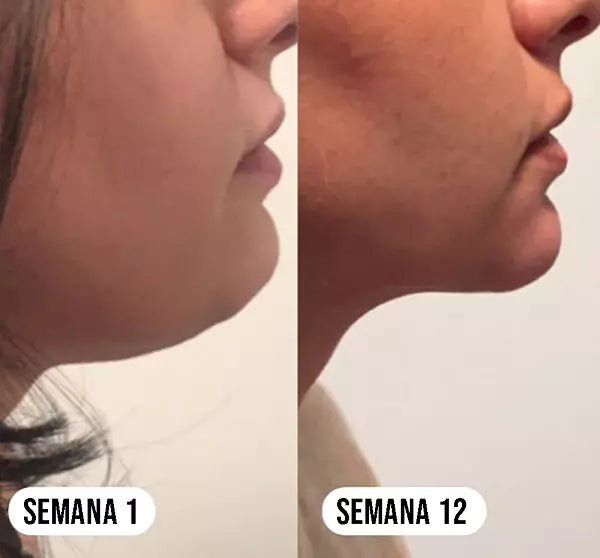 ARETES REDUCTORES DE LIBRAS