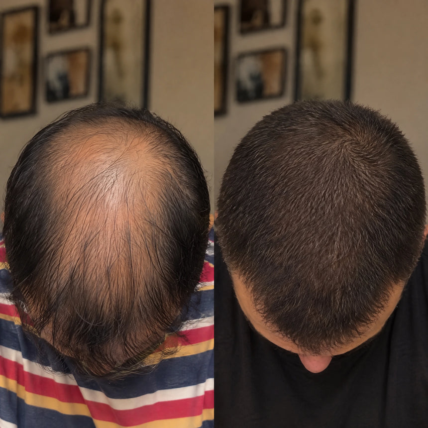 Coronilla antes y después